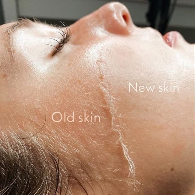 3 Dermaplane Package at Marisa Benakos in Chicago, IL