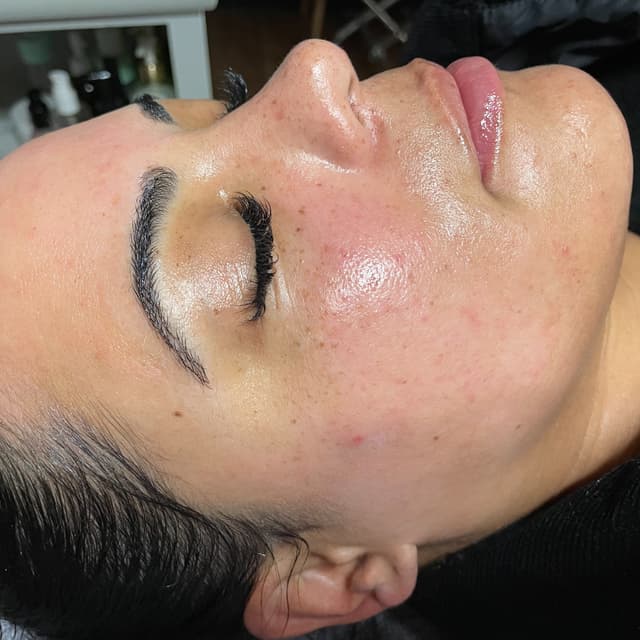 3 Dermaplane Facial Package at Marisa Benakos in Chicago, IL